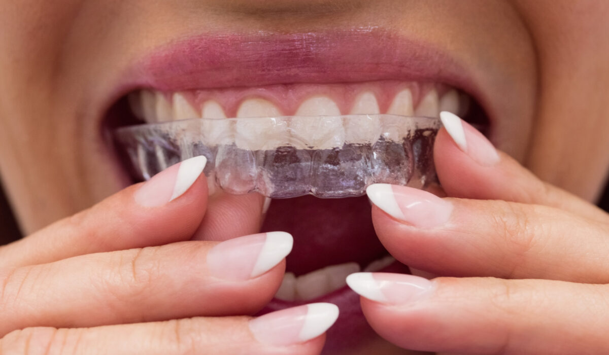 L'orthodontie par aligneurs