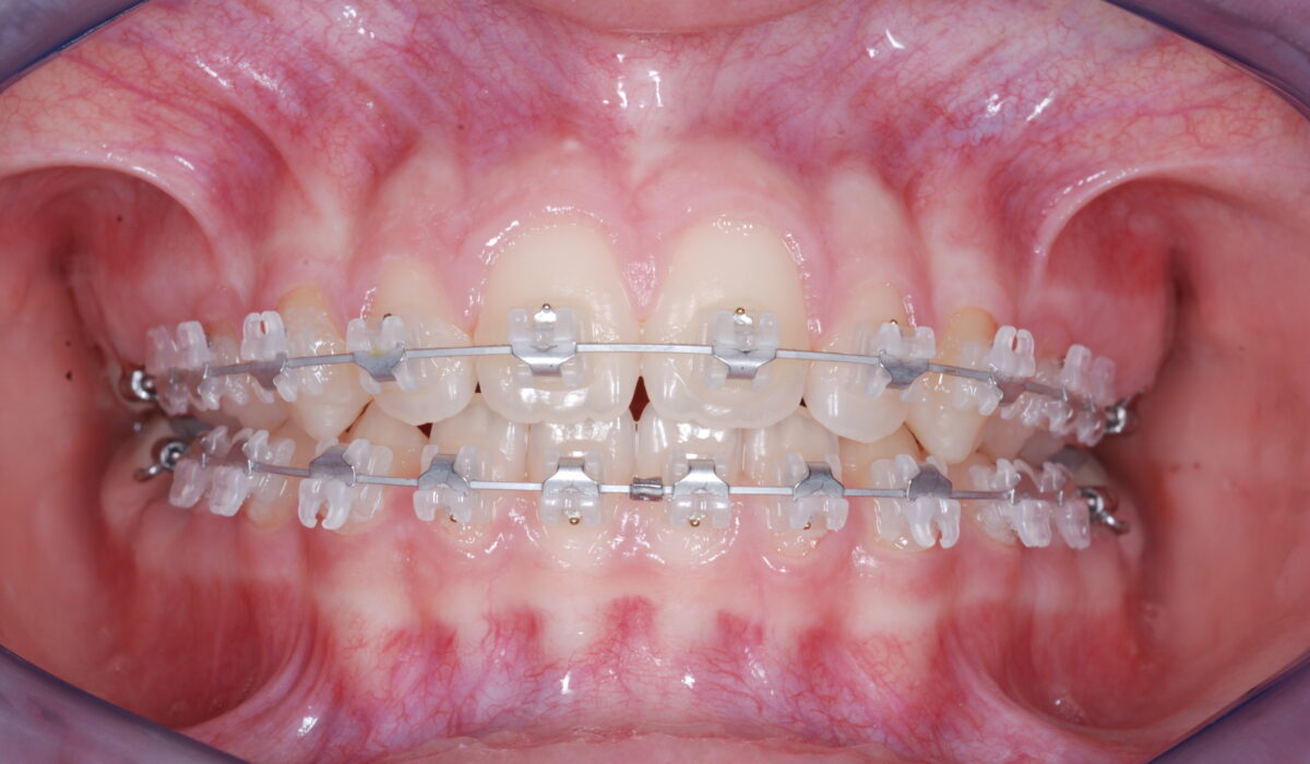 Les bagues en céramique