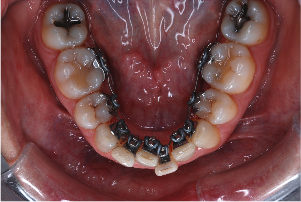 L'orthodontie linguale (avant)