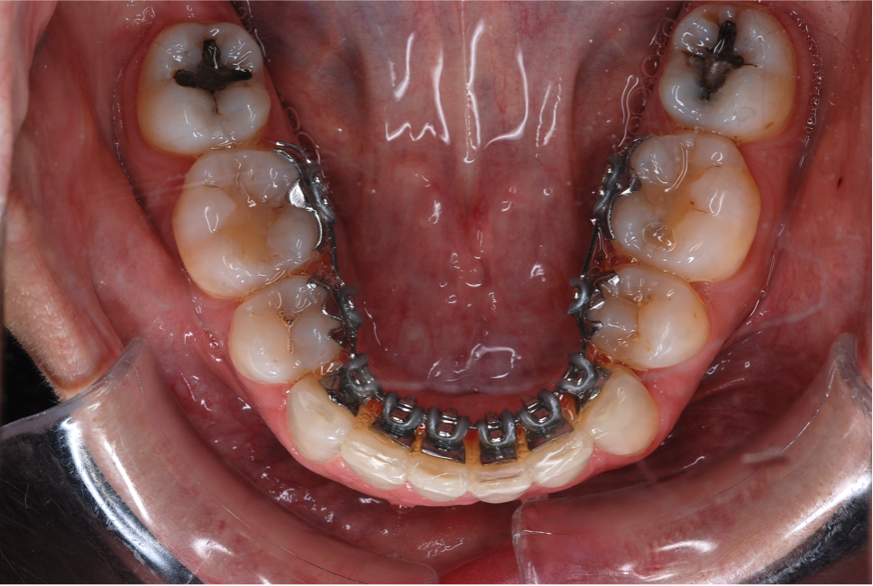 L'orthodontie linguale (après)